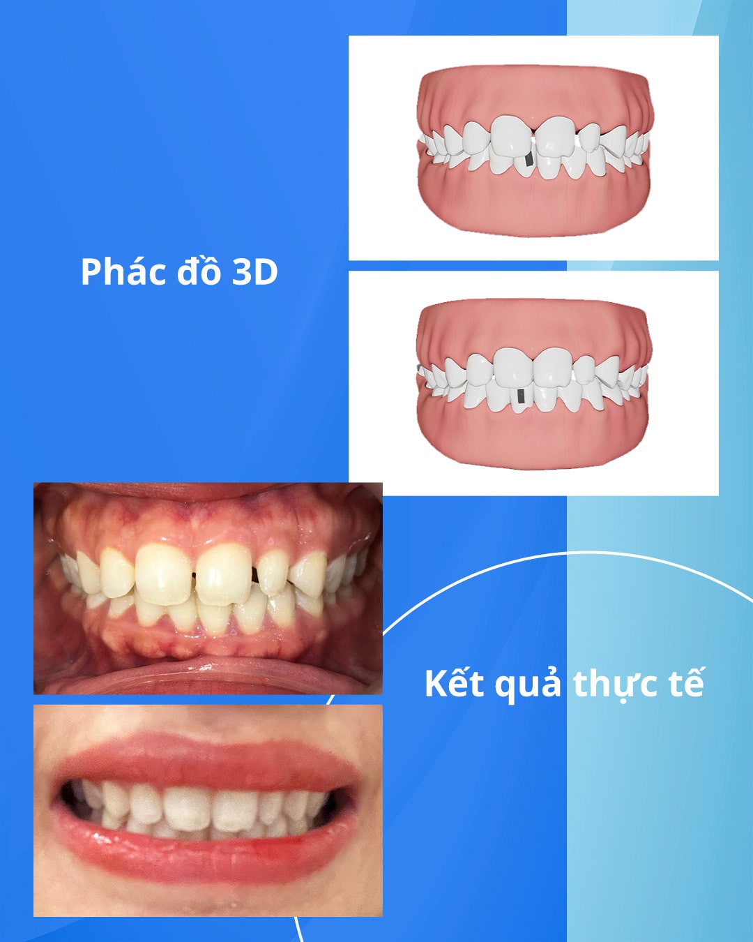 Thấy rõ sự dịch chuyển của răng chỉ từ tháng thứ 3 với Niềng răng.jpg